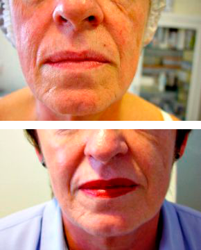 Rejuvenecimiento facial, antes (superior) y después (inferior) de su tratamiento con luz pulsada IPL.